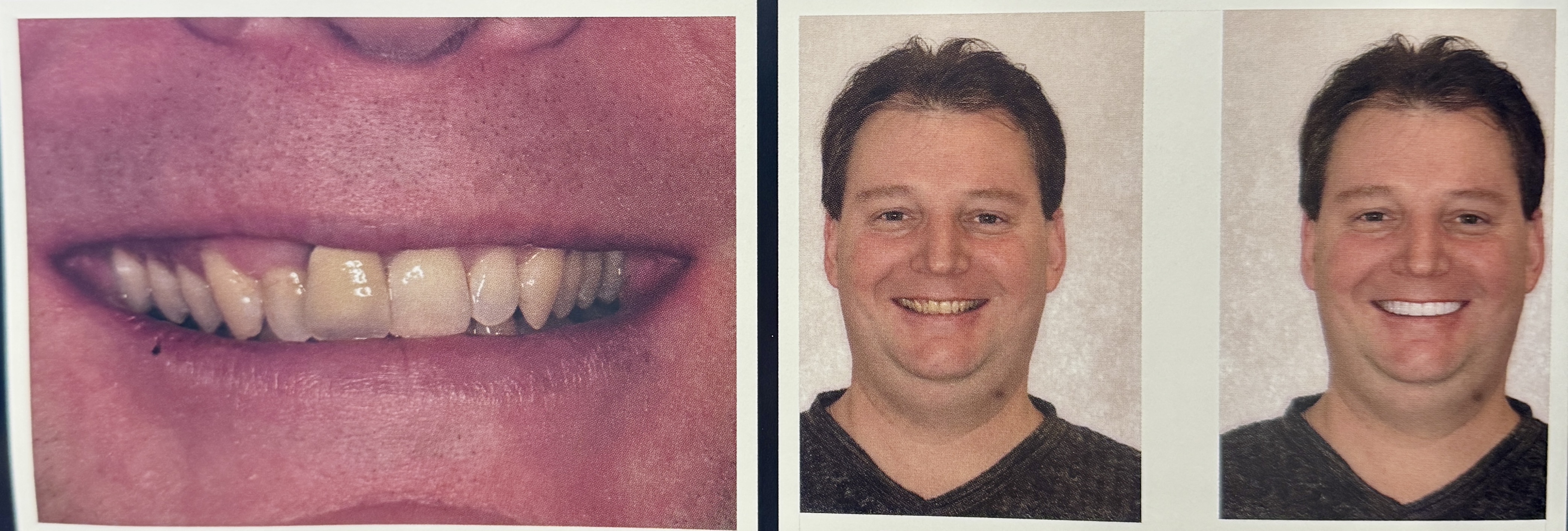 Before treatment: worn, discolored, and misaligned teeth affected both the appearance of the smile and overall facial aesthetics.